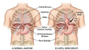 Diyafram Fıtığı (Hiatal Herni)