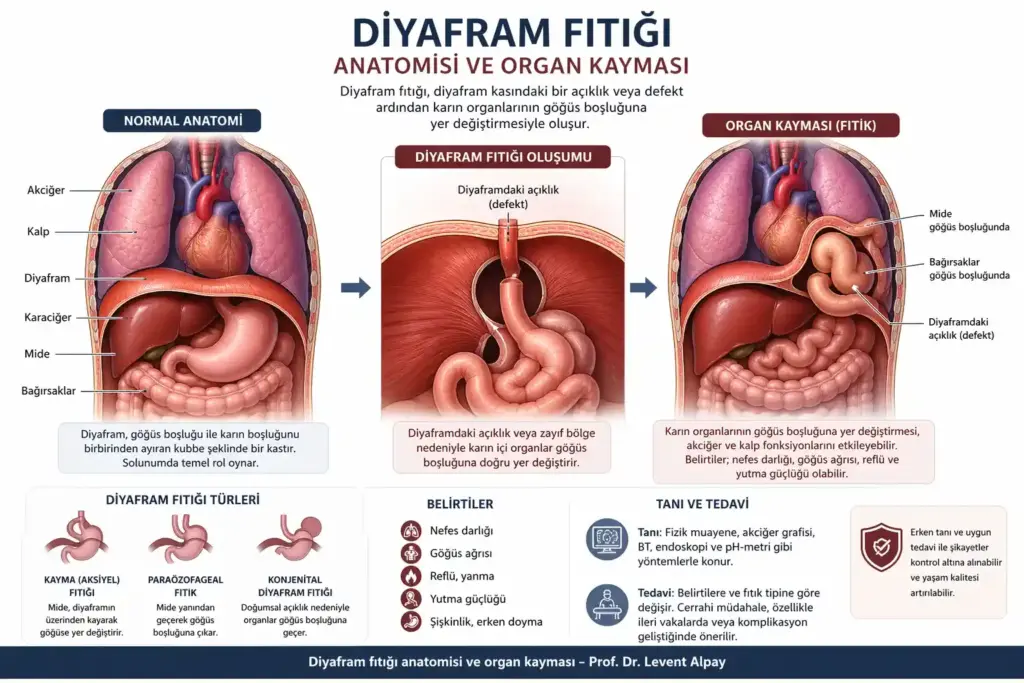 Diyafram Fıtığı (Hiatal Herni) 1 Normal diyafram anatomisi ile diyafram fıtığı (hiatal herni) arasındaki farkı gösteren tıbbi şema; midenin göğüs boşluğuna doğru yer değiştirmesi ve fıtık alanı detayları.