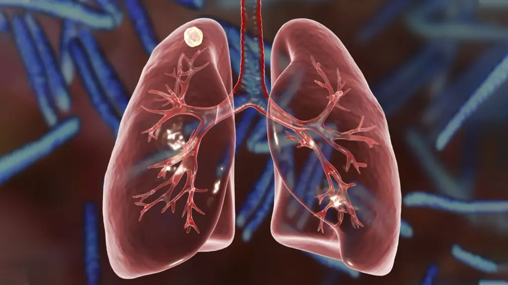 When Do Nodules Detected in the Lung Indicate Cancer?