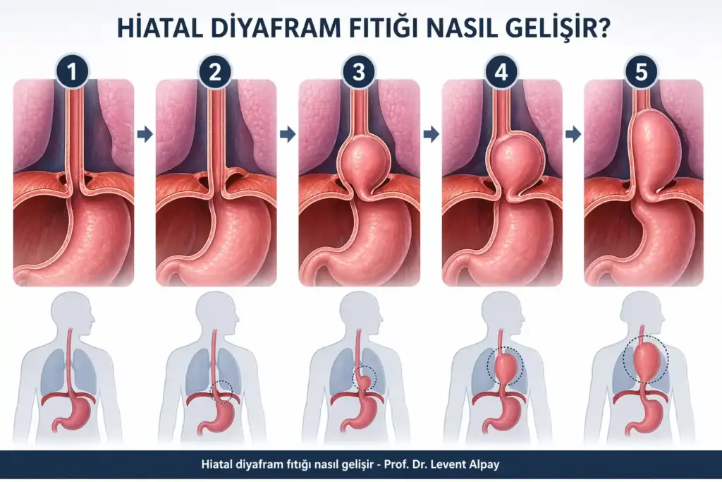 Diyafram Fıtığı (Hiatal Herni) 2 Diyafram fıtığının gelişim aşamalarını gösteren infografik