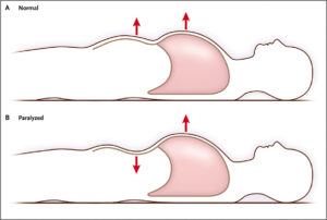 Diaphragm Paralysis (Diaphragmatic Paralysis)