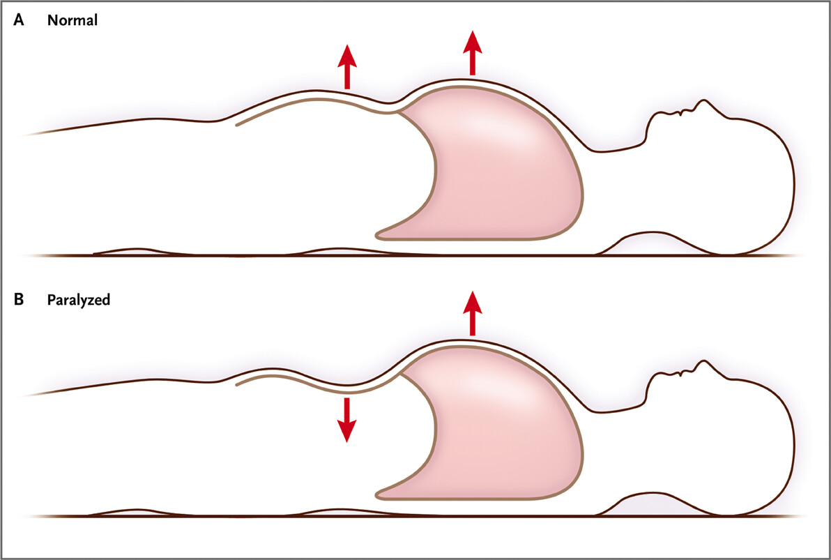 Diyafram Felci (Diyafragma Paralizisi)