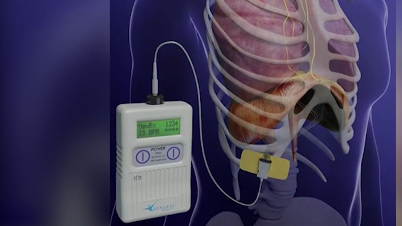 Diyafram Pili Uygulamaları (Diyafragma Pacing)