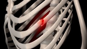 علاج وجراحة كسر الأضلاع