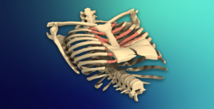 Pectus Excavatum (Pigeon Chest)