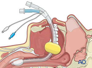 Trachea Strictures and Tumors
