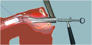 Tracheal Stent Applications (Tracheal Stent)