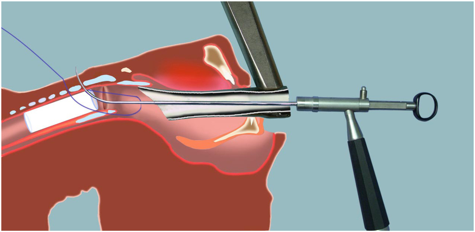 Trakeal Stent Uygulamaları (Nefes Borusu Stenti)